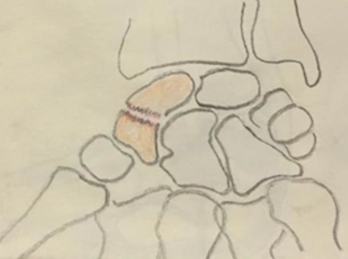 Fracture du scaphoïde Centre de Chirurgie de la Main